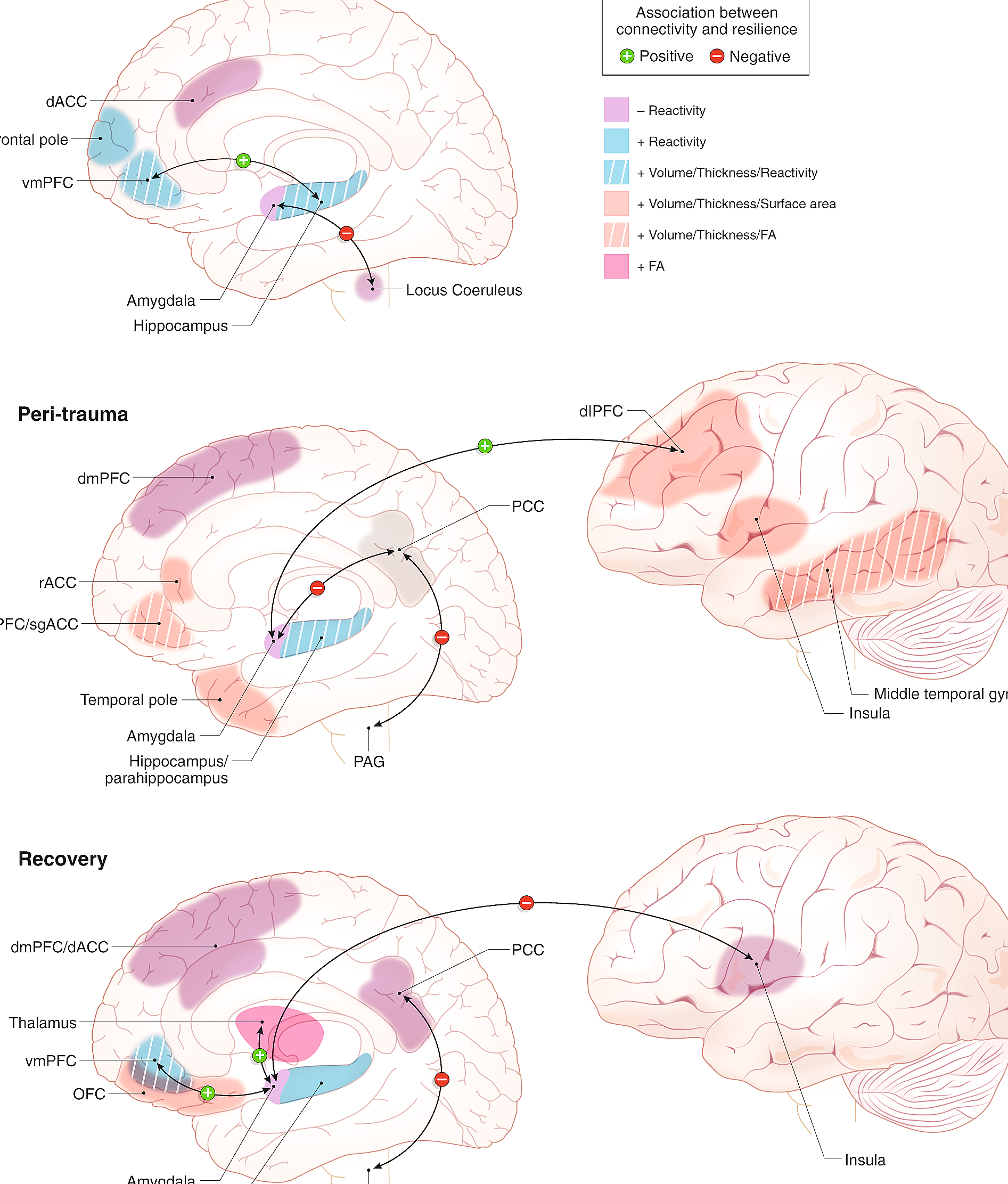 Illustration of brain activating stress response after trauma